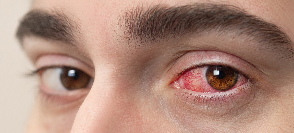 ஸ்ஜோகிரன்ஸ் நோய்க்குறி