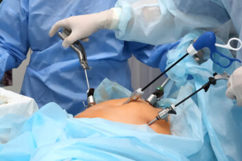 A Big Leap Without the Big Cut: Laparoscopic Surgery, a Boon in Gastroenterology