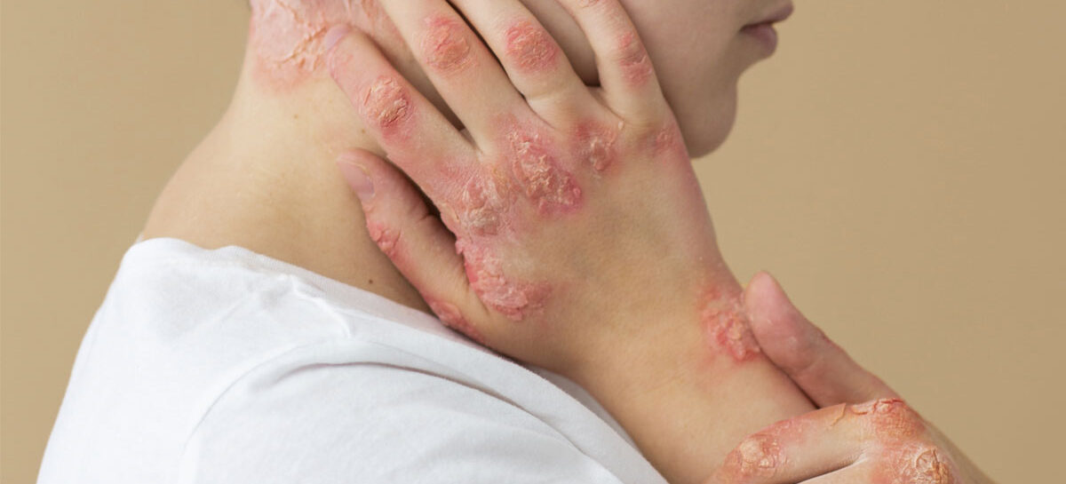 Living with Lupus-Navigating Challenges and Embracing the Journey