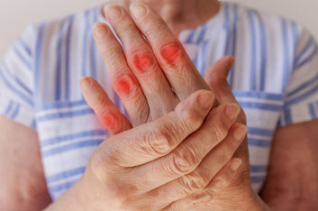 Tips to Manage Arthritis in your Hands