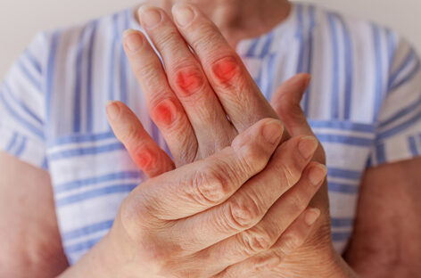 Tips to Manage Arthritis in your Hands