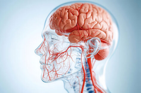 Moya Moya Disease: The Silent Traffic Jam Inside the Brain