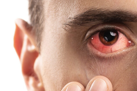Conjunctivitis Outbreak in Chennai – How to Stay Safe