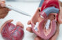 Why Choose Mitral Valve Repair Over Replacement?
