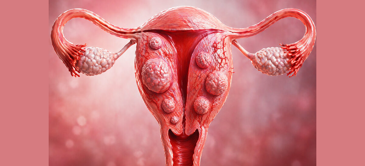 The Pinhole Revolution: Shrinking Fibroids Without Surgery