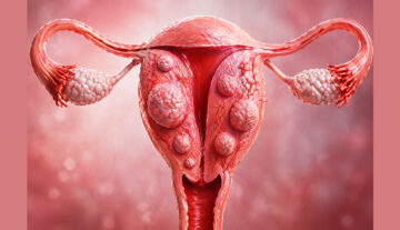 The Pinhole Revolution: Shrinking Fibroids Without Surgery