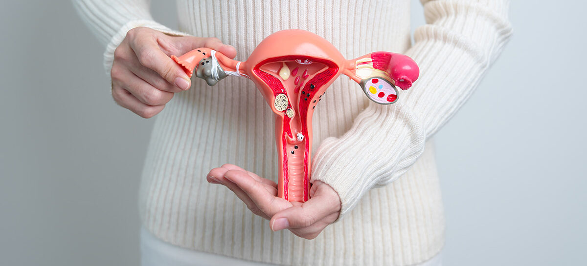 Sexual Health and Psychological Well-being in Polycystic Ovary Syndrome