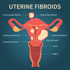 What Exactly Are Fibroids