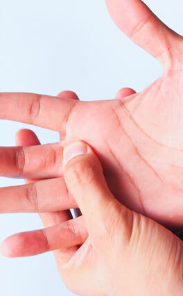 Dupuytren Contractures—A Disease of the Hand
