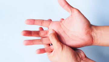 Dupuytren Contractures—A Disease of the Hand