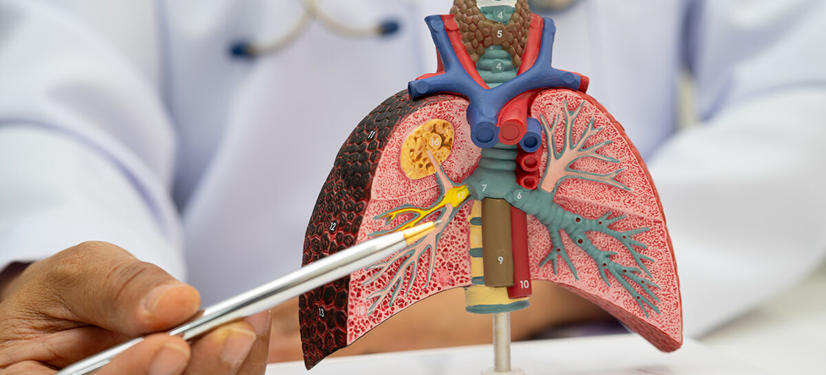 Bronchiectasis Sputum: What are your Mucus Clues telling you?