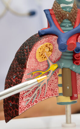 Bronchiectasis Sputum: What are your Mucus Clues telling you?