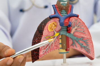 Bronchiectasis Sputum: What are your Mucus Clues telling you?