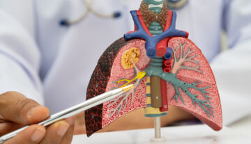 Bronchiectasis Sputum: What are your Mucus Clues telling you?