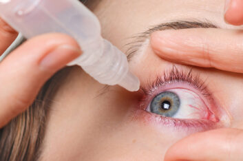 Dry Eyes – Causes and Treatment