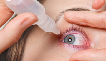 Dry Eyes – Causes and Treatment