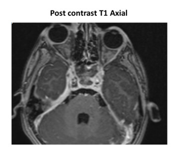 Otomastoiditis With Petrous Apicitis & Cavernous Sinus Thrombosis