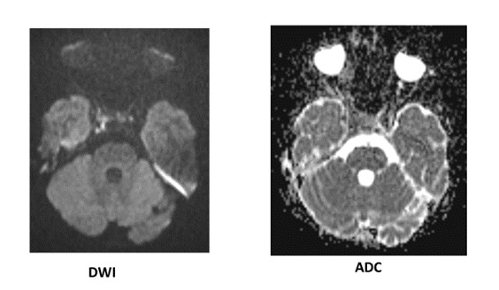 Otomastoiditis With Petrous Apicitis & Cavernous Sinus Thrombosis