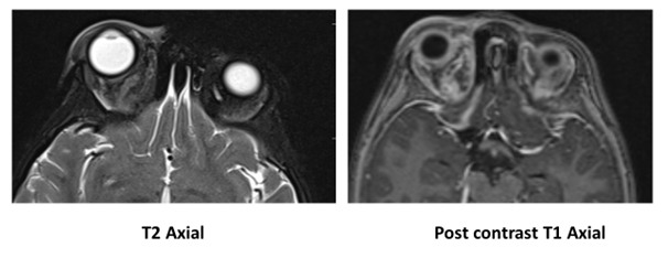Otomastoiditis With Petrous Apicitis & Cavernous Sinus Thrombosis