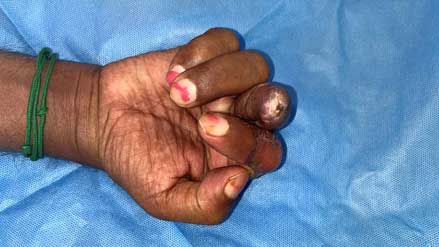 Flexion of finger possible 