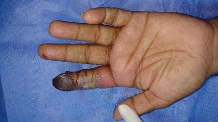 Gangrenous TP & MP region