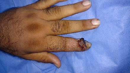 Gangrenous TP region