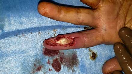Necrotic pulp tissue