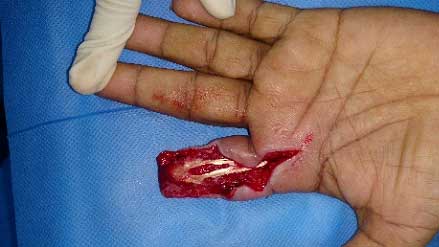 Post debridement