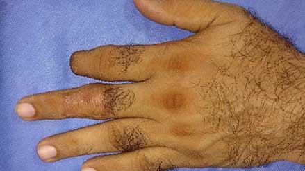 Post op, dorsal aspect