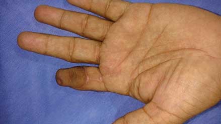 Post op, volar aspect