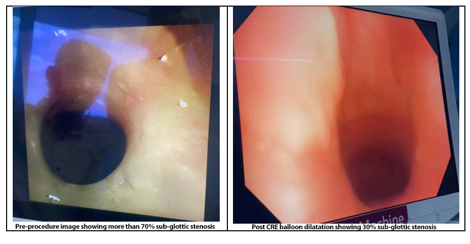 Pre-procedure image showing more than 70% sub-glottic stenosis
