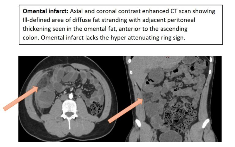 Imaging Spectrum Of Intraperitoneal Focal Fatty Infarction