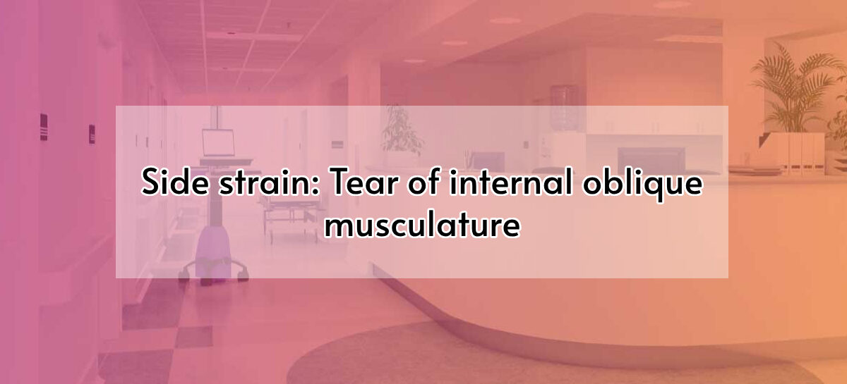 Side Strain: Tear of Internal Oblique Musculature