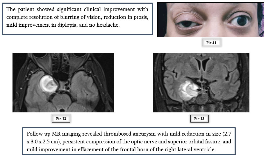 A Vision at Risk: Managing a Cavernous Carotid Aneurysm with Flow Diversion