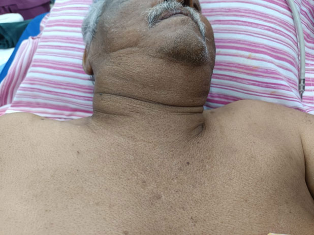 ANAESTHESIA FOR A HUGE MULTIGOIDULAR GOITER