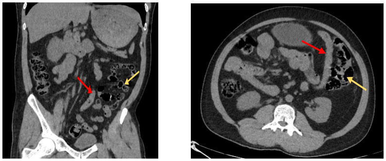 Right Inguinal Hernia With Sigmoid Colon Content: An Embryological Twist