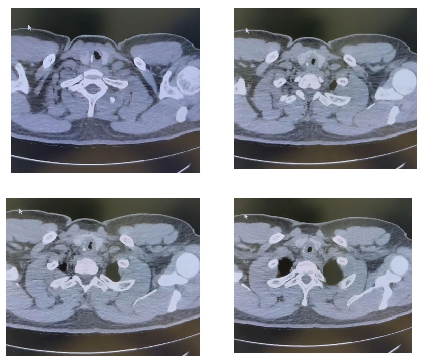 Post-Intubation Subglottic Stenosis: A Case Report and Review of Literature