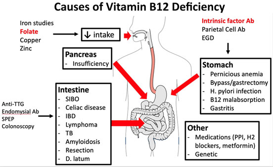 A Hematologic Window to an Intestinal Disease: Crohn’s Disease Presenting as B12 Deficiency