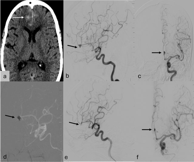 Narrow-Neck Aneurysm with Subacute Grade-1 SAH