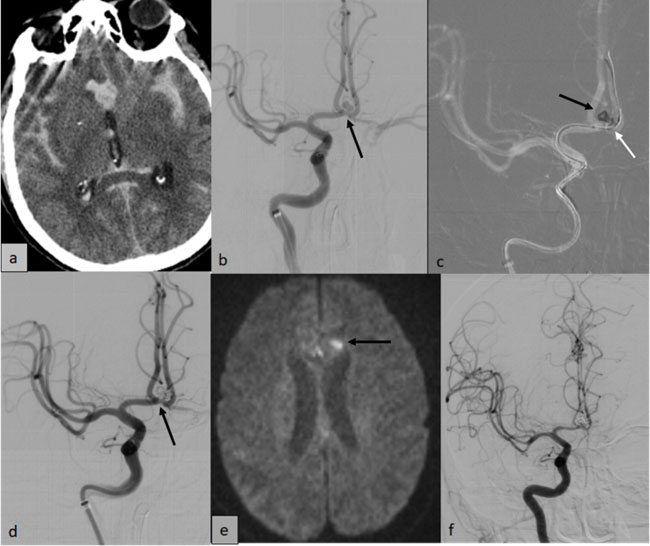 Narrow-Neck Aneurysm with Acute Grade-4 SAH & IVH
