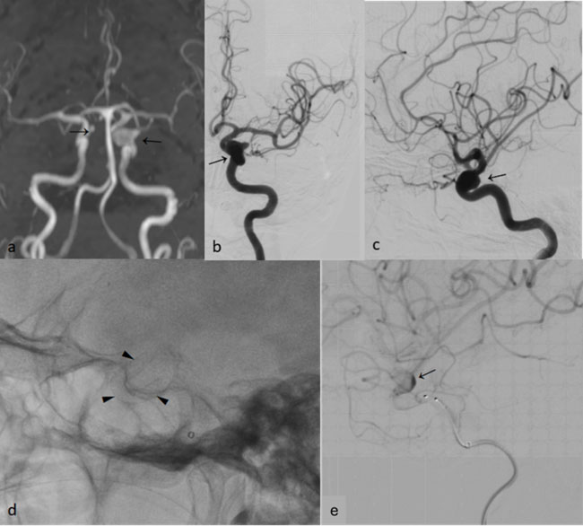 Unruptured Wide-Neck Aneurysm 