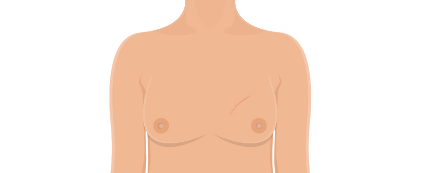 Breast conservation surgery in Chennai