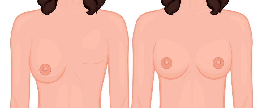 Breast Reconstruction Surgery