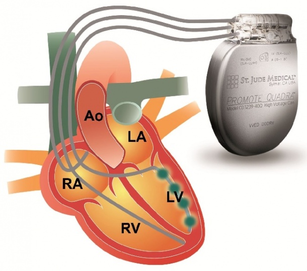 Cardiac Resynchronisation Therapy (CRT)