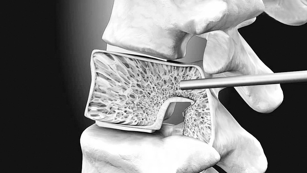 What is Vertebroplasty ? How Vertebroplasty Procedure works for the Broken Spines