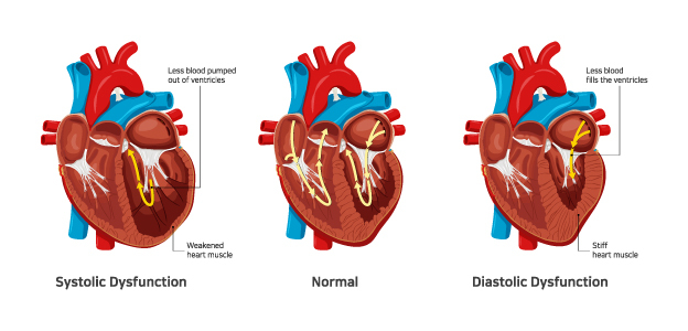 Treatment for Advanced Heart Failure Chennai