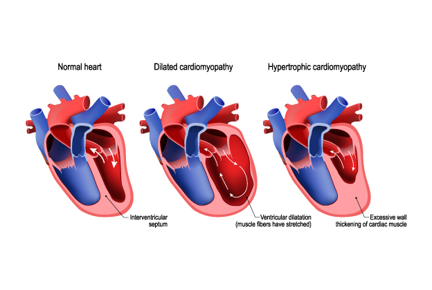 Treatment for Cardiomyopathy in Chennai