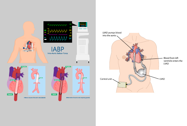 Treatment for Heart Failure in Chennai