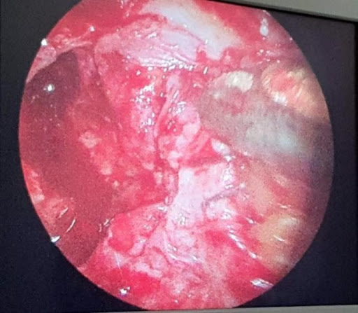 COVID-19-and-Mucormycosis-2