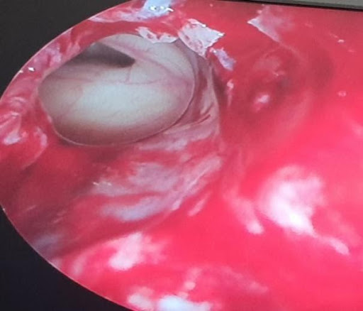 COVID-19-and-Mucormycosis-3